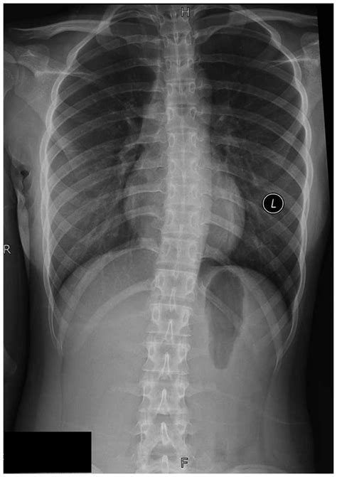 Osteoid Osteoma Of The Rib A Report Of Two Cases
