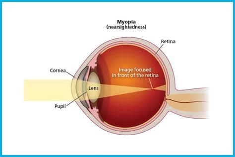 Myopia An Introduction Visionplus Magazine