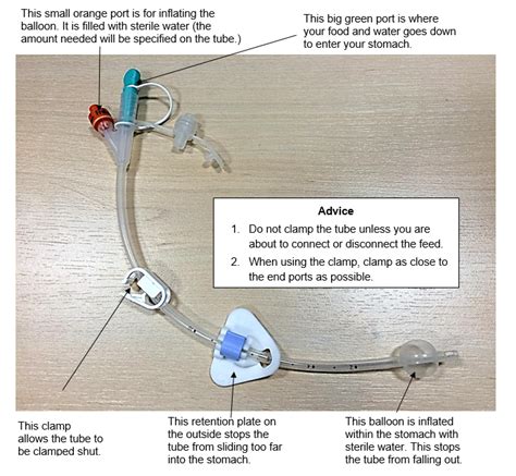 Having And Looking After A Gastrostomy Tube Cuh