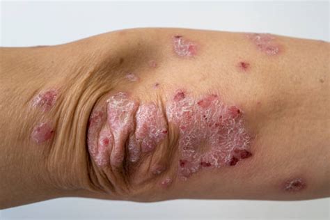 750 Psoriasis Elbow Photos Stock Photos Pictures And Royalty Free