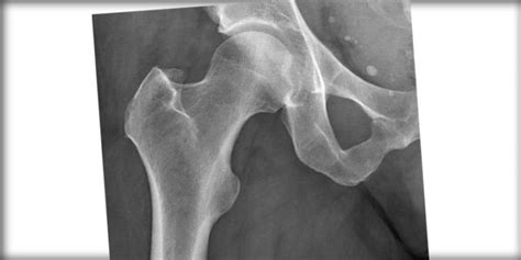 Standing And Supine Radiographs Accurate For Hip Joint Width