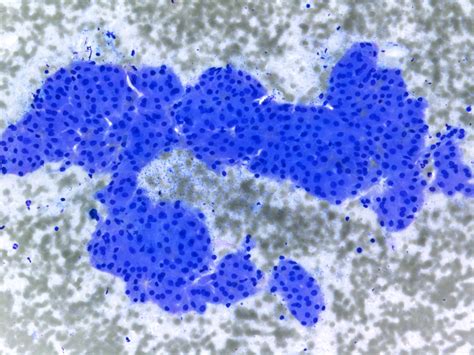 Pathology Outlines Neoplasm Benign