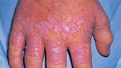 lichen planus facts diagnosis symptoms and treatment