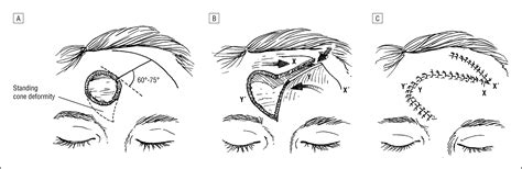 Double Opposing Rotation Advancement Flaps For Closure Of Forehead