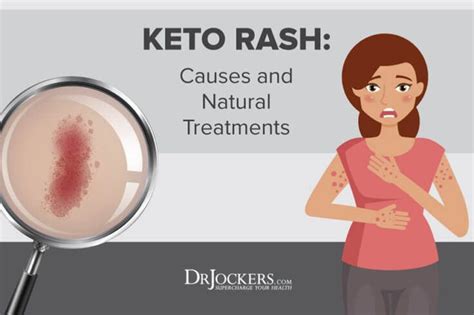 Keto Rash Causes And Natural Treatments Keto Rash Keto Rash Treatment