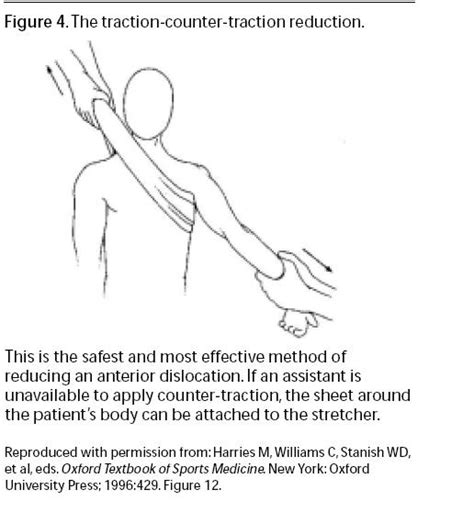 Reduction should be attempted soon (eg, within 30 minutes) after the diagnosis is made. Anterior-inferior shoulder dislocation: a review on the ...