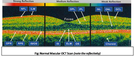 What Is Optical Coherence Tomography Oct Basic Interpretation