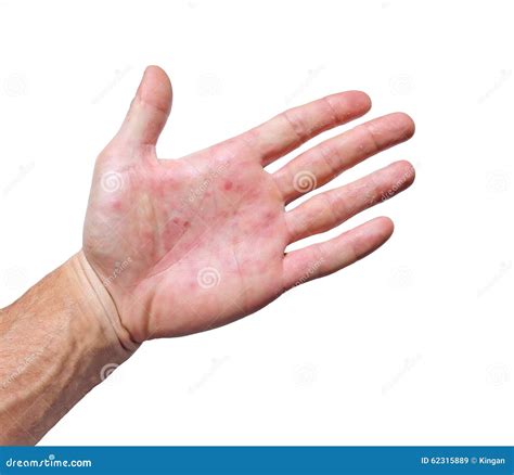 Palm Patient Erythema In Red Spots From Inflammation Stock Image