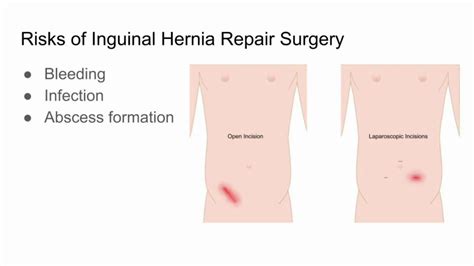 Inguinal Hernia Bowel Exit Through The Wall Of The Abdomen Cavity Stock