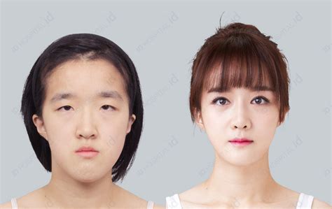 No1 Korean Plastic Surgery Id Hospital Asia Beauty Center