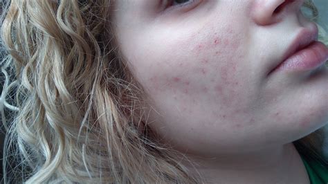 Roaccutane 30mgfor 6 Months Pictures Included Page 4 Accutane