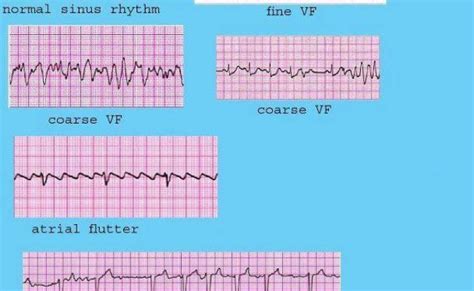 Ventricular Arrhythmias Ecg Ekg Interpretation Part 5 Otosection