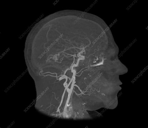 Brain Haemorrhages Mri Angiogram Stock Image C0552505 Science