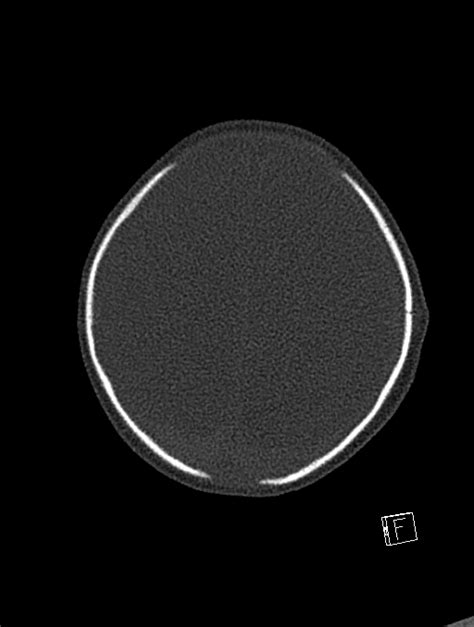 Bilateral Subdural Hemorrhage And Parietal Skull Fracture Radiopaedia