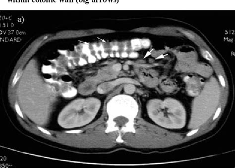 Figure 4 From Diffuse Nodular Lymphoid Hyperplasia Of The