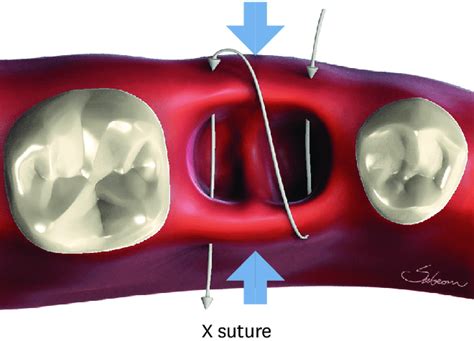 X Suture Or Conventional X Suture The Needle Passes Through Over The
