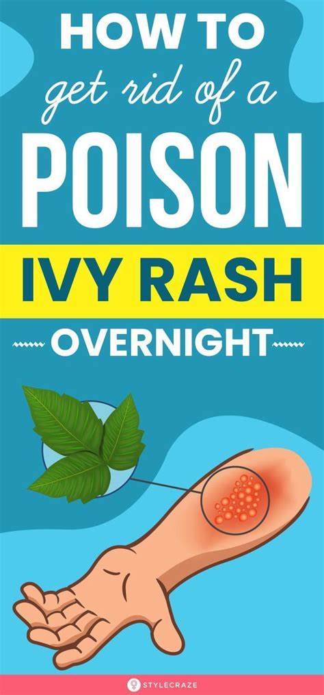 How To Get Rid Of A Poison Ivy Rash Overnight In 2022 Poison Ivy Rash