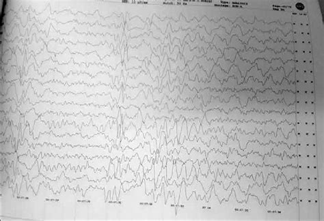 Electroencephalogram Showing Periodic Lateralized Epileptiform