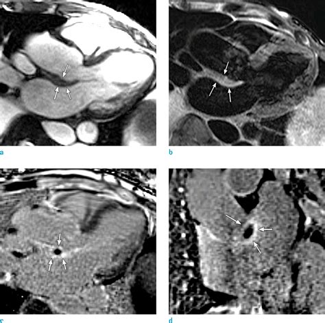 Detection Of Perivalvular Abscess With Late Gadolinium Enhanced Mr