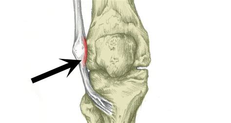 Iliotibial Band Syndrome Runners Knee