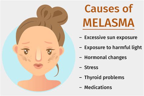Melasma Causes Symptoms And Medical Treatment