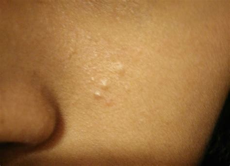 Small Bumps That Aren T Pimples On Face General Acne Discussion