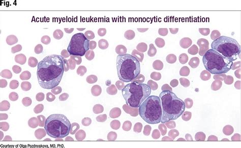 Close Up On Abnormal Monocyte Morphology In Peripheral Blood Smears