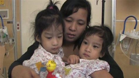 California Medics Separate Two Year Old Conjoined Twins Bbc News