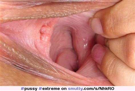 Cervix On