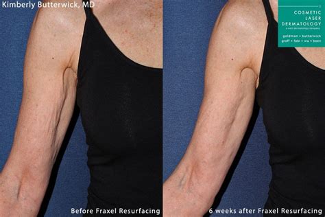 Crepey Skin Arm Treatment San Diego Ca Clderm