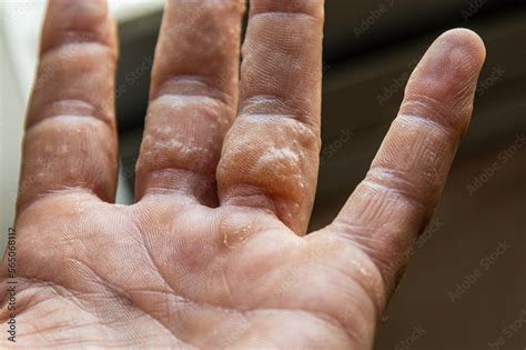 Rash On Fingers Dyshidrotic Eczema Stock 写真 Adobe Stock