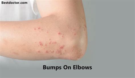 Skin Colored Bumps On Elbows
