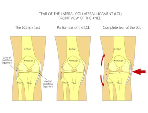 Medial Collateral Ligament Or MCL Injury Of The Knee What To Do