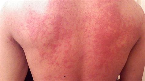 Hives Rash Treatment Home Remedies