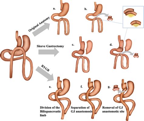 Revisional Operative Techniques Following Mini Gastric Bypass One Download Scientific Diagram