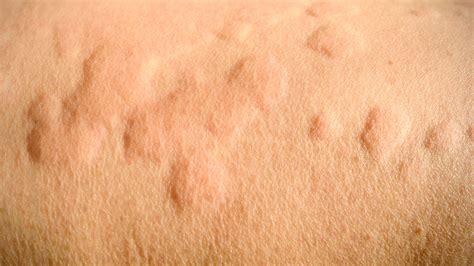 Urticaria Hives Dermatology Co Dermatology Co