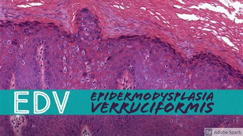 Epidermodysplasia Verruciformis Edv Minute Pathology Pearls Youtube