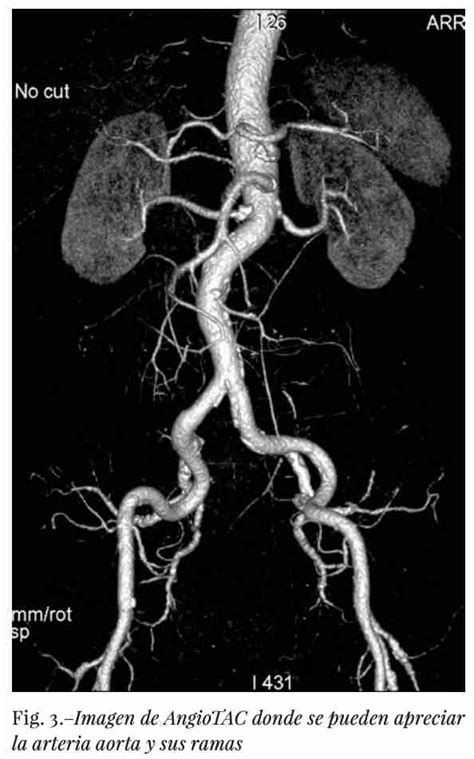 Anatomia De Los Vasos Sanguineos Sistema Arterial Arteria Aorta Ramas De La Aorta Tor Cica