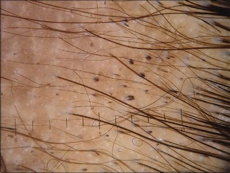Each hair in your body grows out of a tiny pouch known as a follicle. View Image