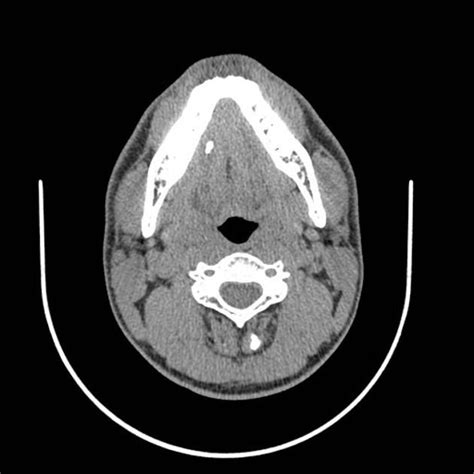 Submandibular Duct Stone Radiology Case