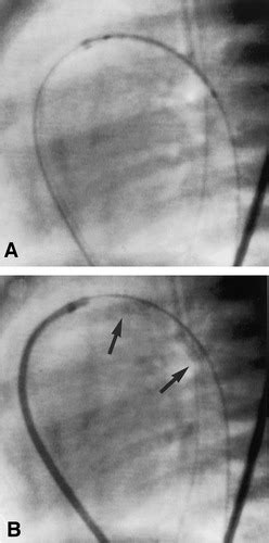 Stenting The Neonatal Arterial Duct In Duct Dependent Pulmonary