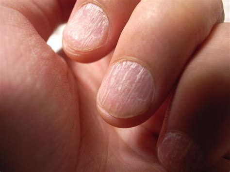 What These Common Nail Problems Could Be Telling You About Your Health