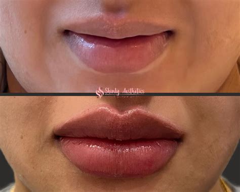 Russian Lip Filler Before After Results Skinly Aesthetics