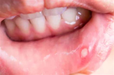 Canker Sores Causes Symptoms And Treatments