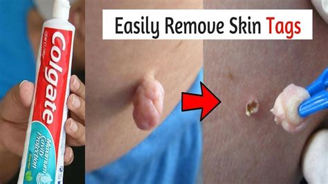 how to remove skin tags naturally overnight with garlic best skin tags removal remedy in 1