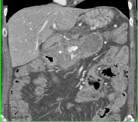 Active Bleed In The Duodenum CTisus Com Medical Imaging Bowels Radiology Pediatrics Case