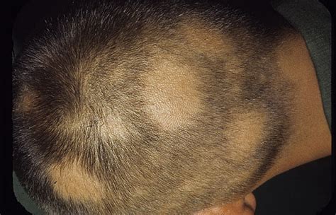 Painful Lump Under Scalp 4 Hard Bump On The Scalp Causes How To