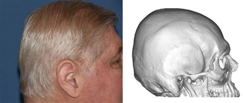 Blog Archivecase Study Senior Skull Augmentation With Two Stage