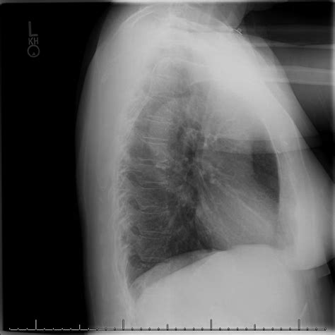 Hennepin Ultrasound Sternal Fracture Missed On X Ray