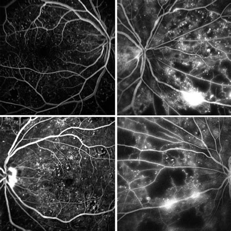 Pdf Retinal Vasculopathy As First Manifestation Of Chronic